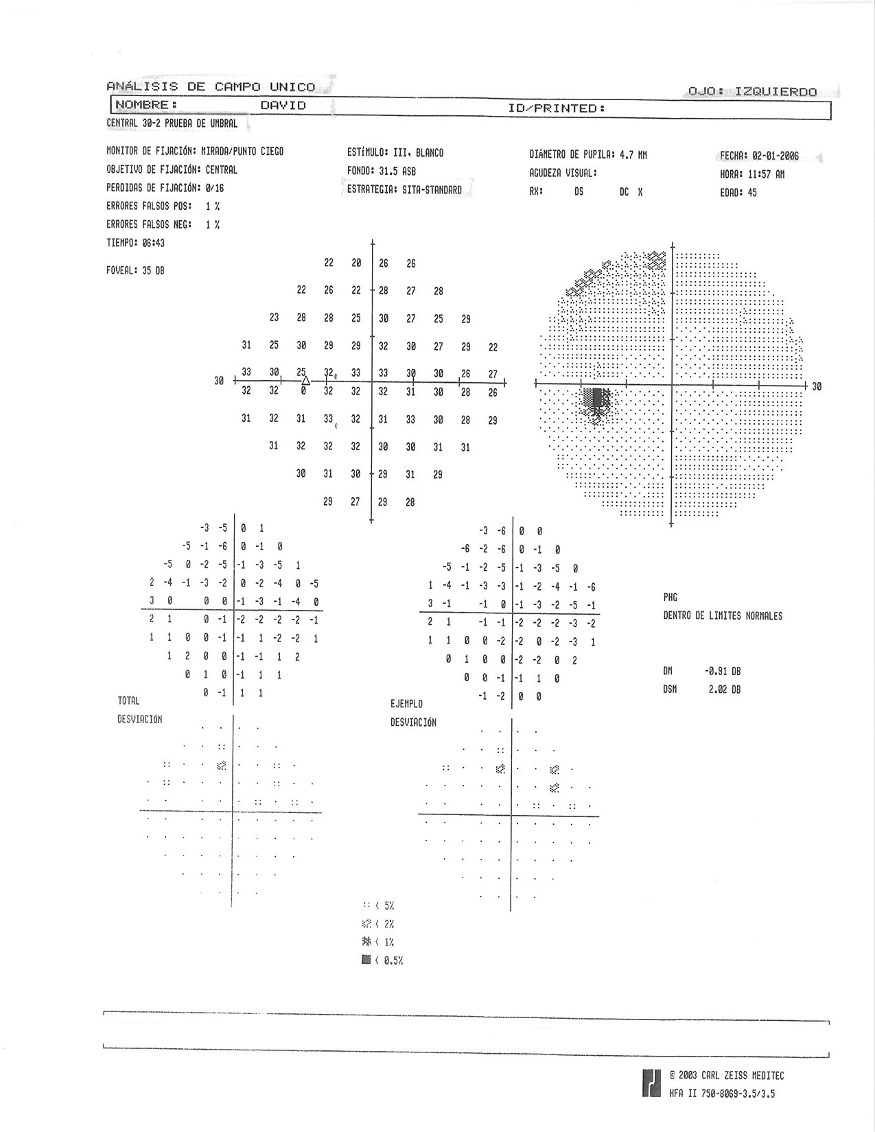 My First Follow up Visual Field Results FitEyes